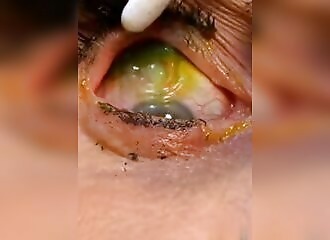 She forgets to remove her contact lenses from her eyes ... 23 times